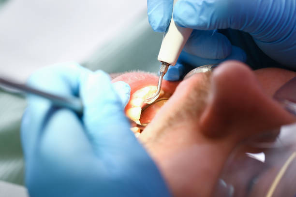 Best Emergency Root Canal Treatment in Bellevue, NE
