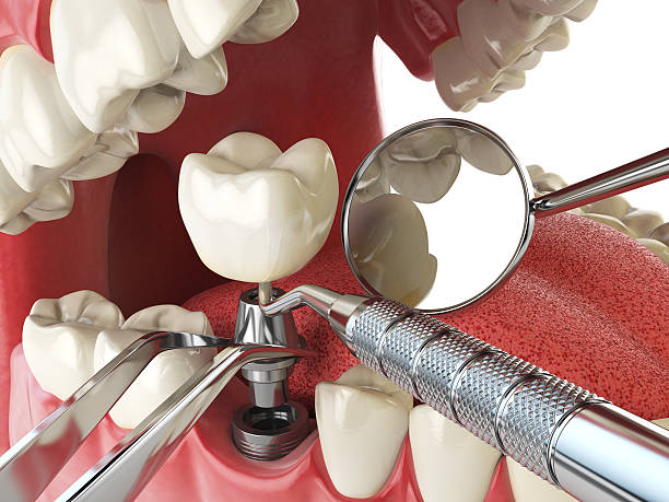 Best Emergency Treatment for Dental Infections or Abscesses in Bellevue, NE